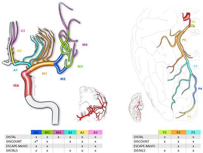 Current challenges in the endovascular treatment of medium vessel occlusions